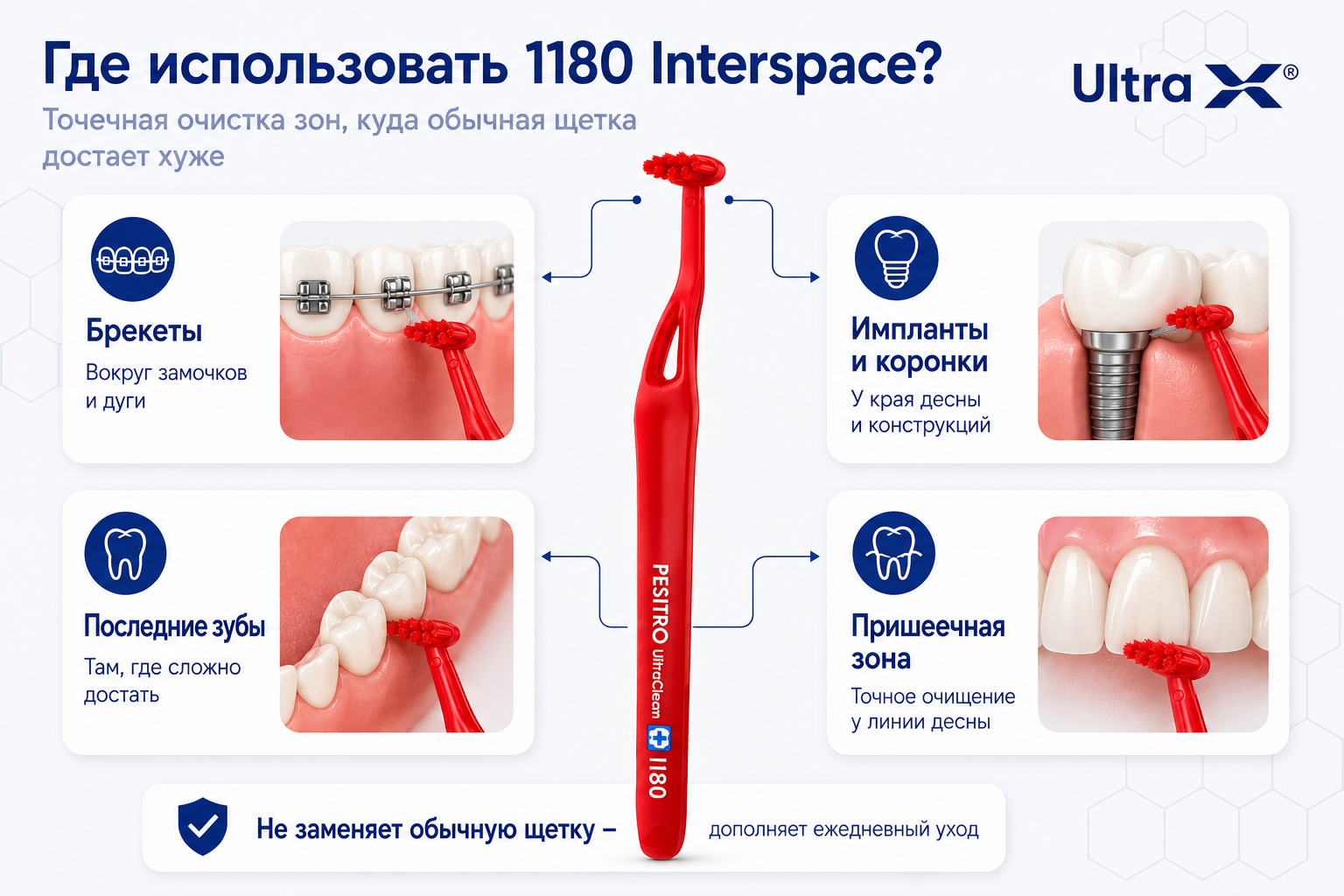 Инфографика PESITRO 1180 Interspace: брекеты, импланты, последние зубы, пришеечная зона
